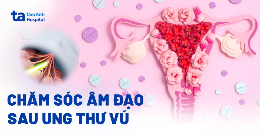 Cách chăm sóc âm đạo sau ung thư vú hiệu quả và an toàn