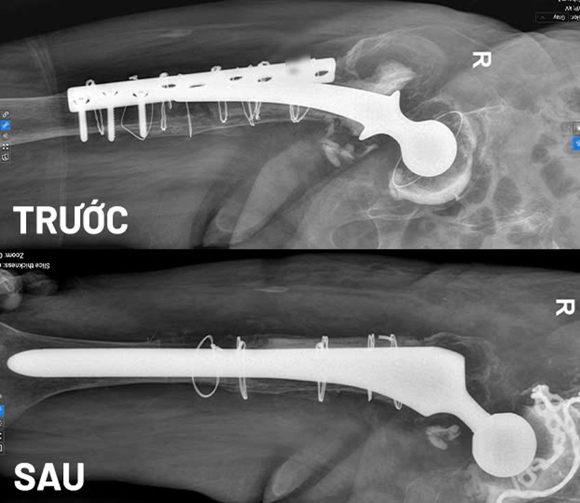 ảnh chụp mri trước và sau khi bệnh nhân thay khớp háng
