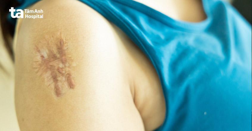 ảnh sẹo lồi ngứa