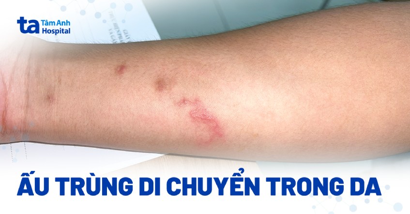 Nam thanh niên bị ấu trùng di chuyển khắp người