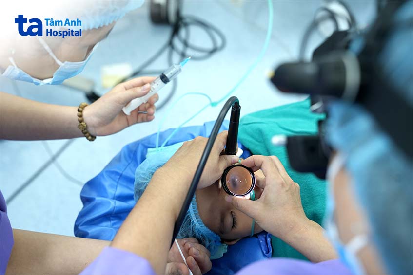 bác sĩ thực hiện kỹ thuật lạnh đông điều trị u nguyên bào võng mạc