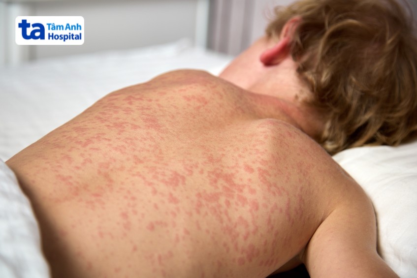 Ban đỏ nổi khắp người ở trẻ bị sởi