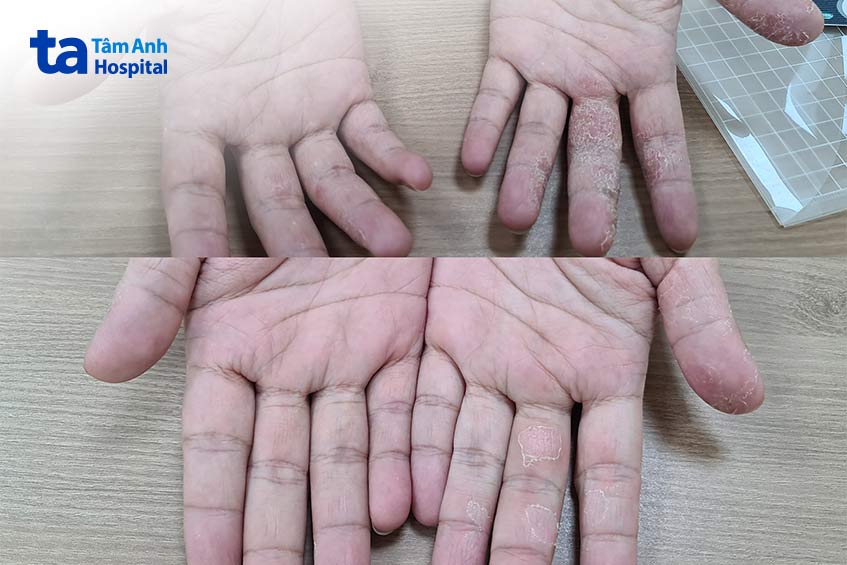 bàn tay nhiễm nấm của một người bệnh sau một tuần điều trị