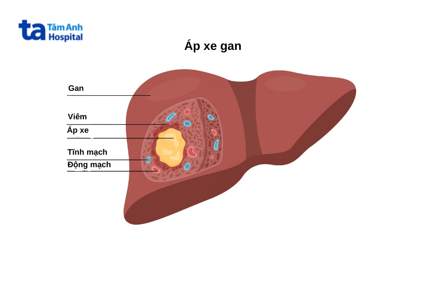 bệnh áp xe gan