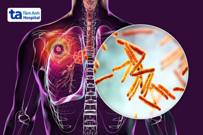 Bệnh lao phổi là một tình trạng nhiễm trùng phổi 