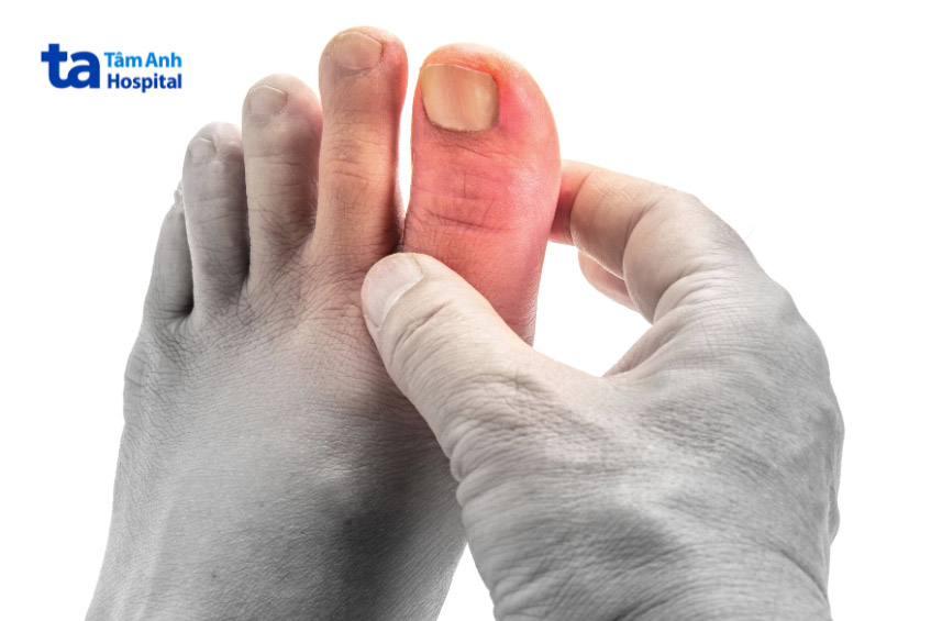 Bệnh nhân có biến chứng bị đau, sưng ở ngón chân cái (một dấu hiệu của bệnh gout)