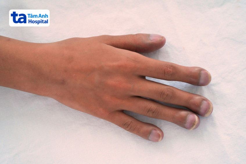 Bệnh nhân mắc hội chứng Eisenmenger với biểu hiện ngón tay dùi trống