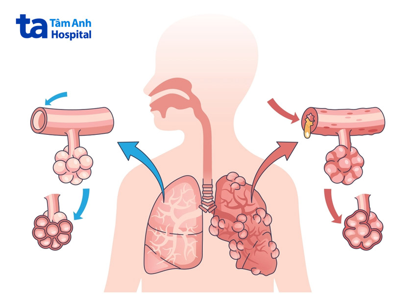 bệnh phổi tắc nghẽn mạn tính