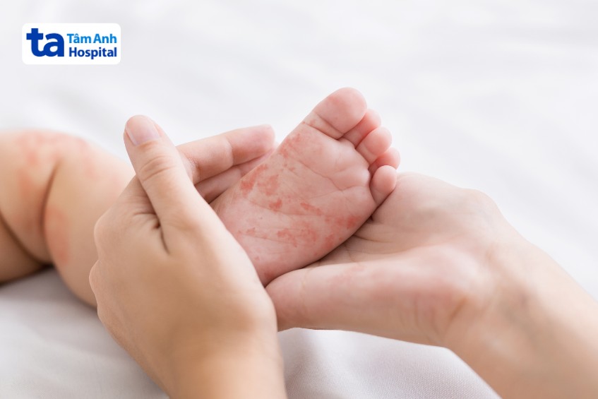bệnh sởi gây phát ban trên da