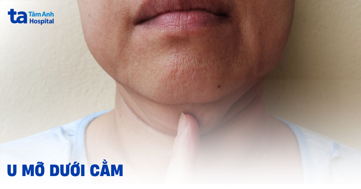 Nổi hạch dưới cằm (trái, phải): Nguyên nhân, dấu hiệu nhận biết