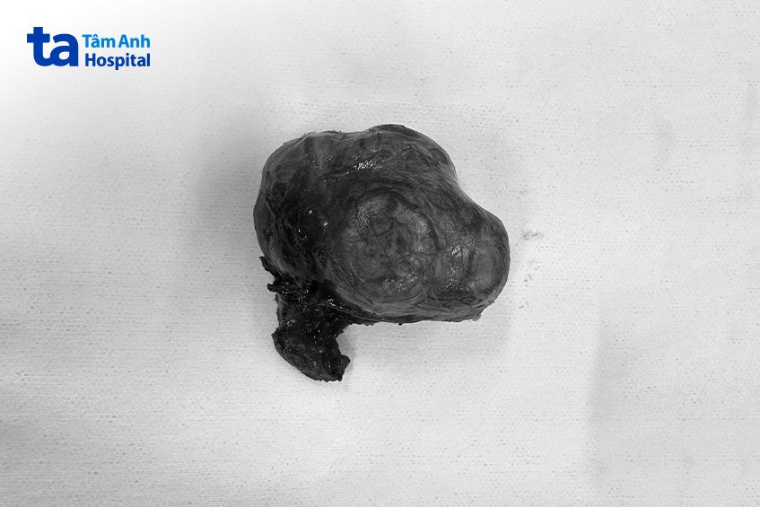 Bướu giáp của bà H to khoảng 6cm được cắt bỏ