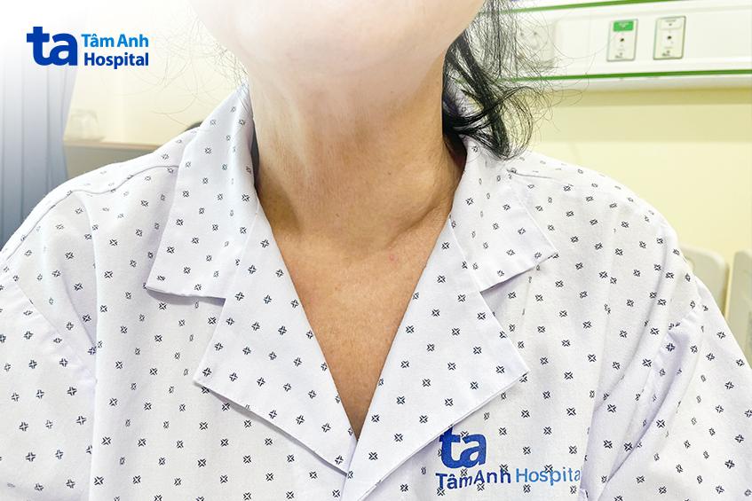 Bướu giáp ở thùy trái tuyến giáp phình to