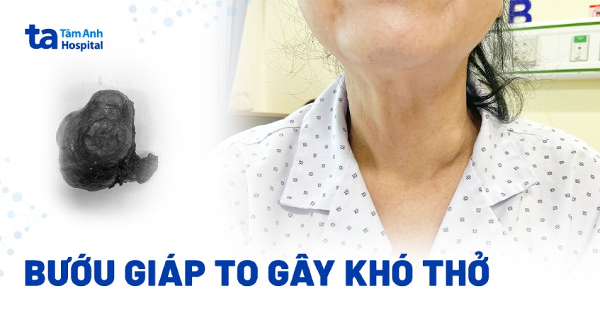 Bướu giáp to gây khó thở