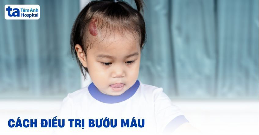 4 cách điều trị bướu máu và chi phí chữa bệnh