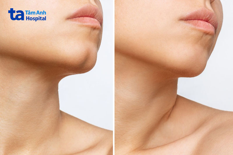 Cằm chẻ Cằm chẻ