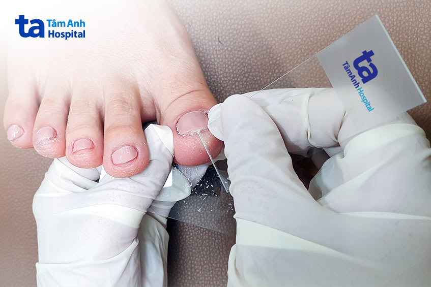 cạo lớp bột dưới móng chân lấy mẫu bệnh phẩm xét nghiệm