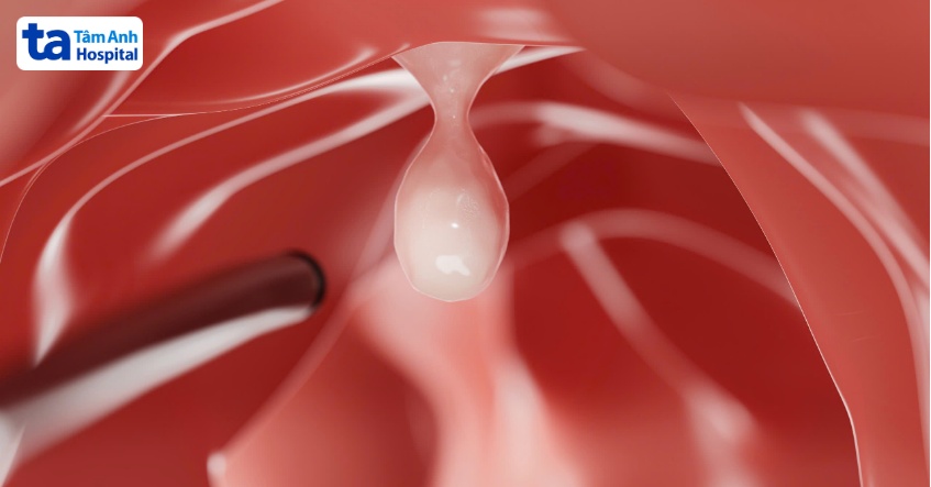 cắt tách dưới niêm mạc ống tiêu hóa