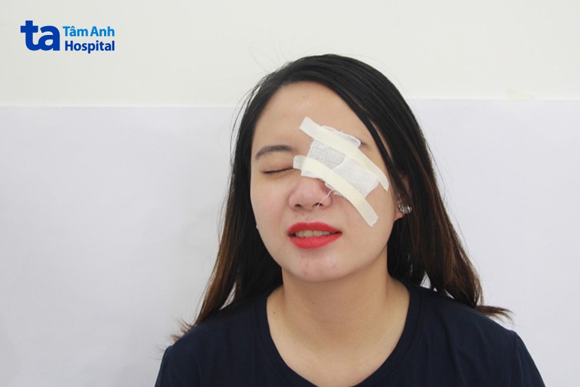 chấn thương mắt dễ bị glocom góc đóng