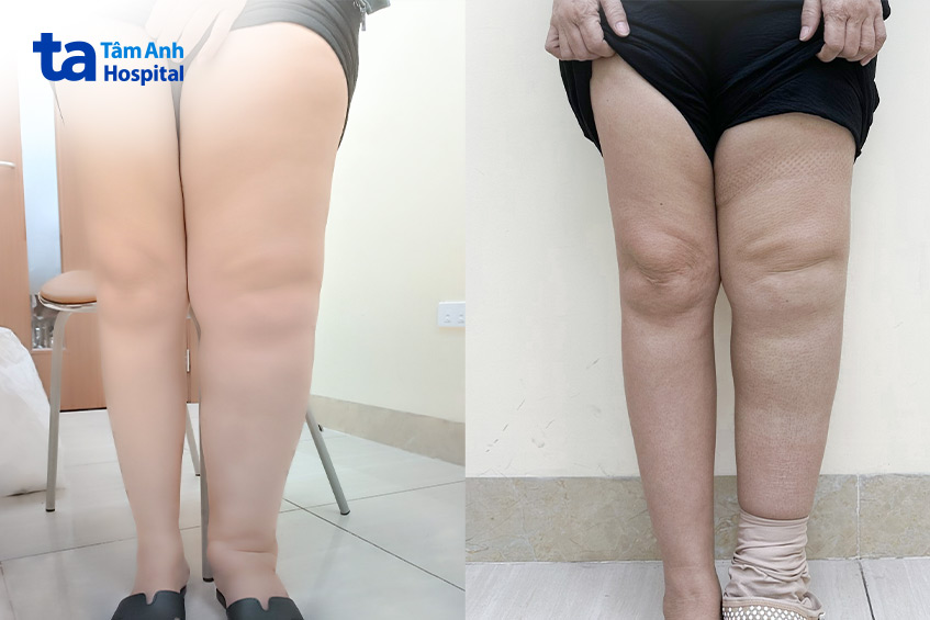 Chân trái bệnh nhân to gấp đôi chân phải (hình A) và được thu nhỏ 50% sau điều trị (hình B)