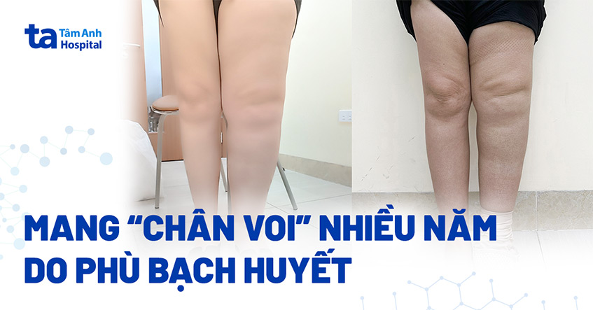 Chân trái to gấp đôi chân phải do phù bạch huyết