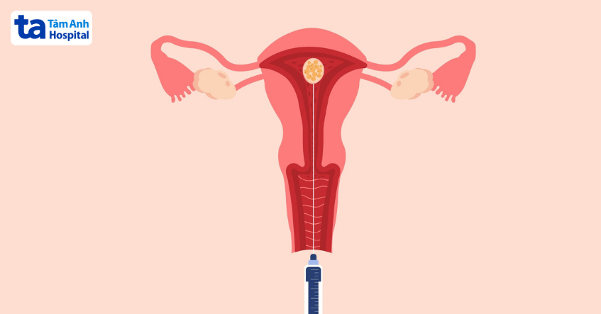 Chuyển phôi tươi ngày 3 thường được chỉ định tùy từng trường hợp cụ thể