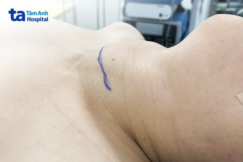 Cổ bệnh nhân sưng to do bệnh Basedow cường giáp