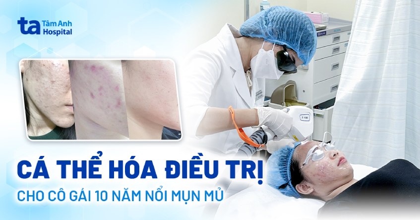 Cá thể hóa điều trị cho cô gái 10 năm nổi mụn mủ