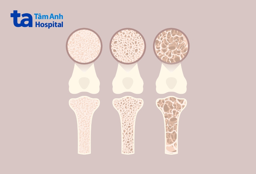 cơ xương và khớp sau hóa trị