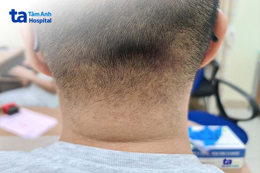 da đầu một nam bệnh nhân do nấm