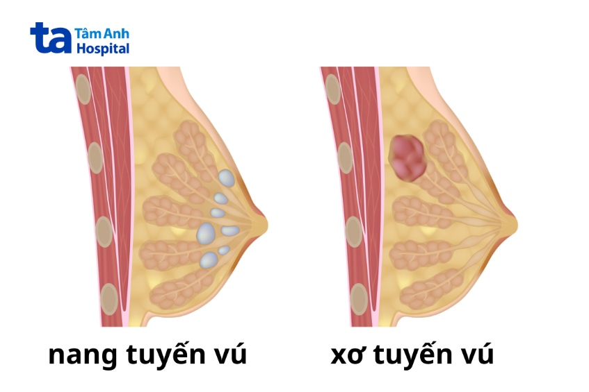 dạng khối u vú lành tính phổ biến