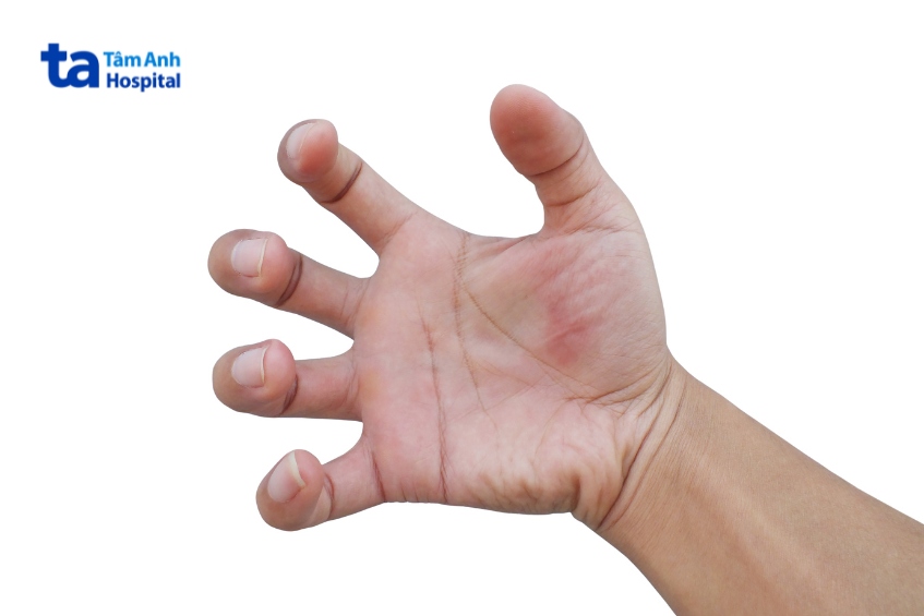 dấu hiệu động kinh cần sơ cứu đúng cách