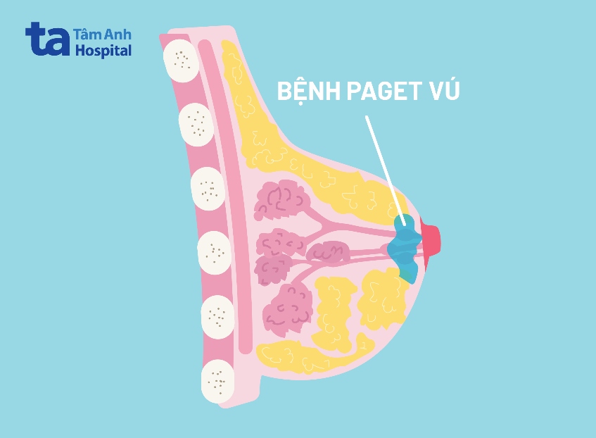 đầu ti bị đóng vảy