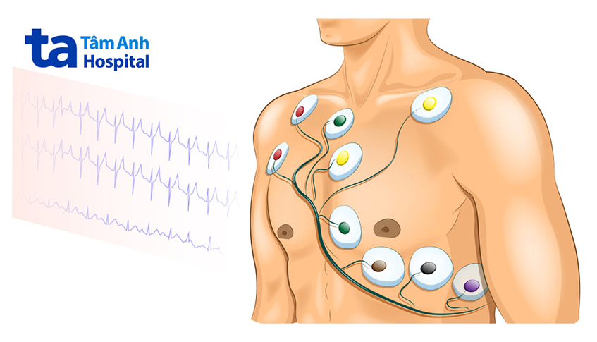 Điện tâm đồ đánh giá chức năng tim được thực hiện trong khám tiền mê