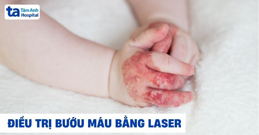 Điều trị bướu máu bằng laser có nên hay không? Khi nào nên áp dụng?