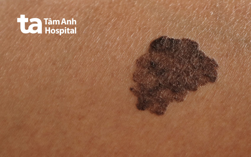 đốm nâu do ung thư không những không biến mất mà còn xuất hiện nhiều hơn