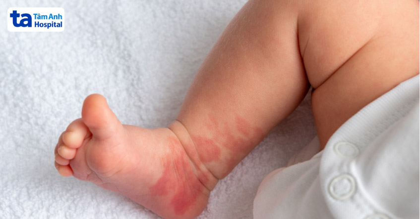 dùng thuốc bôi bướu máu theo đúng chỉ dẫn của bác sĩ