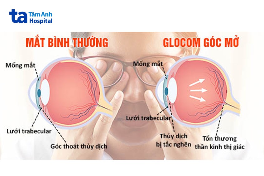 glocom góc mở và glocom mắt thường