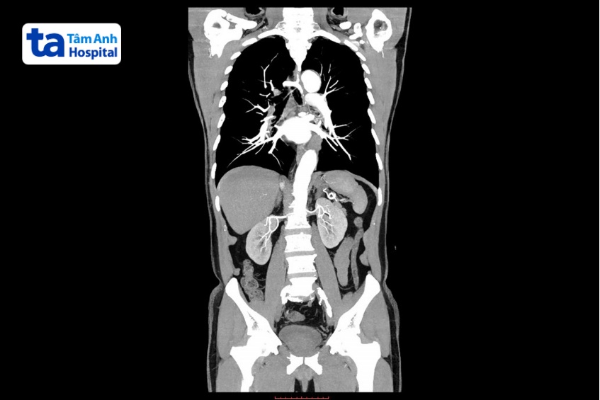 hình ảnh CT ngực bụng chậu