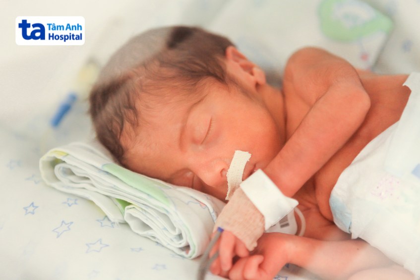 Hình ảnh em bé sinh non 31 tuần tuổi đang được chăm sóc đặc biệt