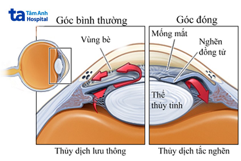 hình ảnh glocom góc đóng