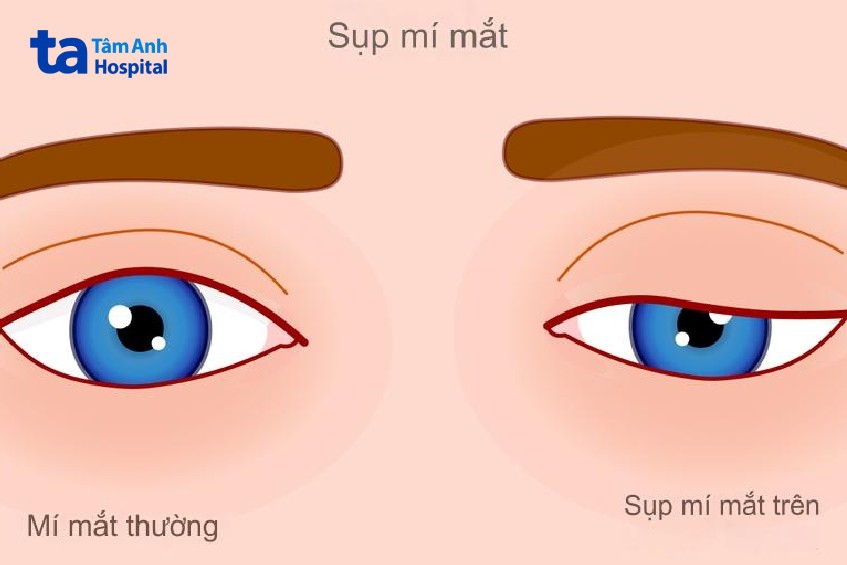 hình ảnh mắt sụp mí sau khi ngủ dậy
