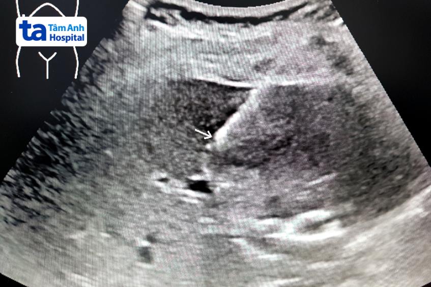 hình ảnh sinh thiết gan siêu âm