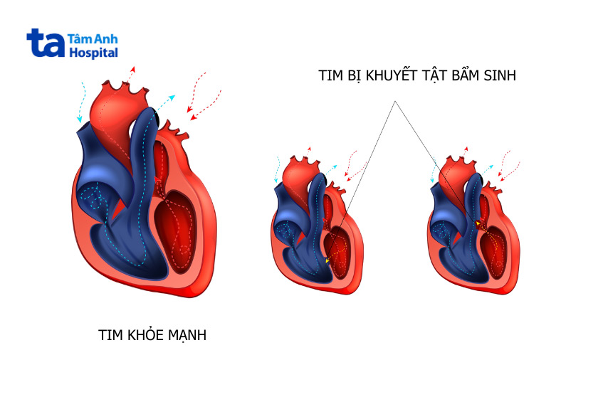 Hình ảnh tim khỏe mạnh (bên phải) và tim bị dị tật bẩm sinh (bên trái)