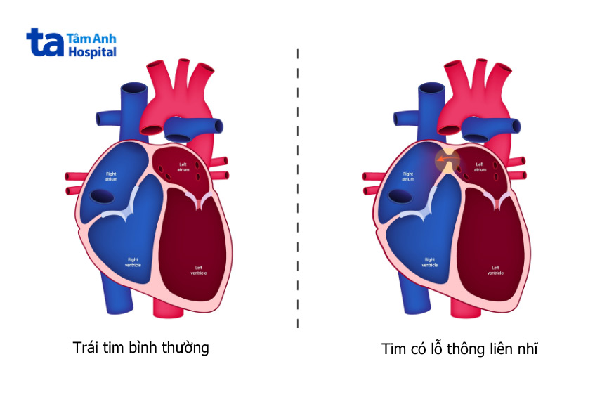 Hình ảnh trái tim bình thường và trái tim bị lỗ thông liên nhĩ (ASD)