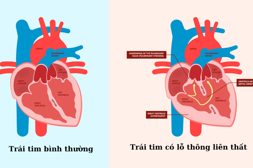 Hình ảnh trái tim bình thường và trái tim có lỗ thông liên thất