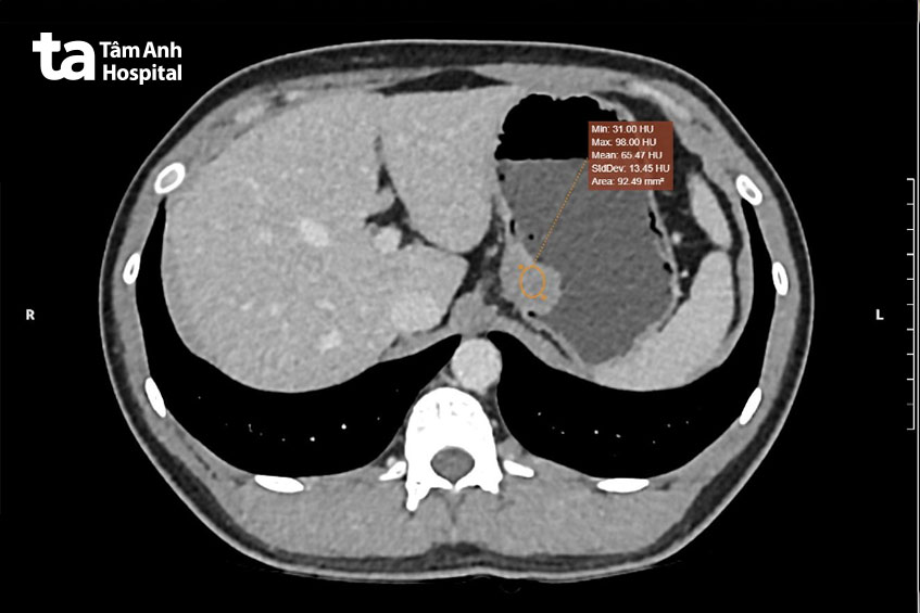 hình ct cho thấy khối u ở tâm vị