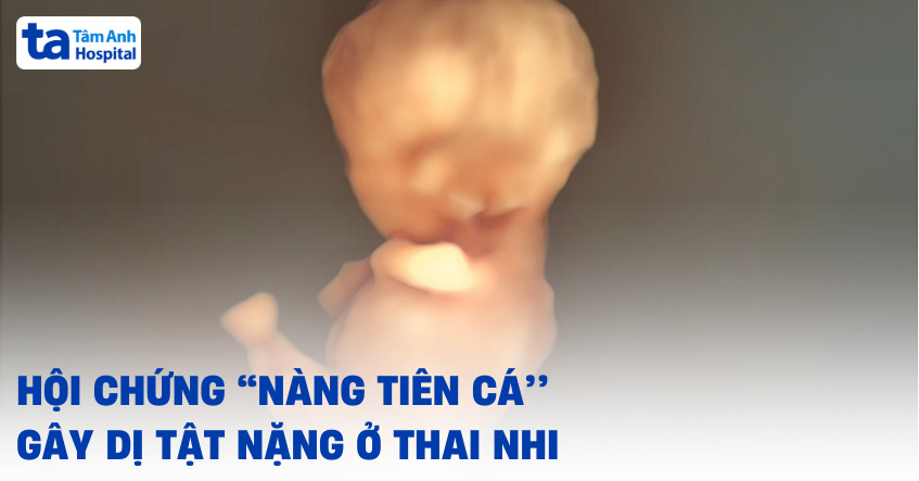 hội chứng nàng tiên cá gây dị tật nặng ở thai nhi
