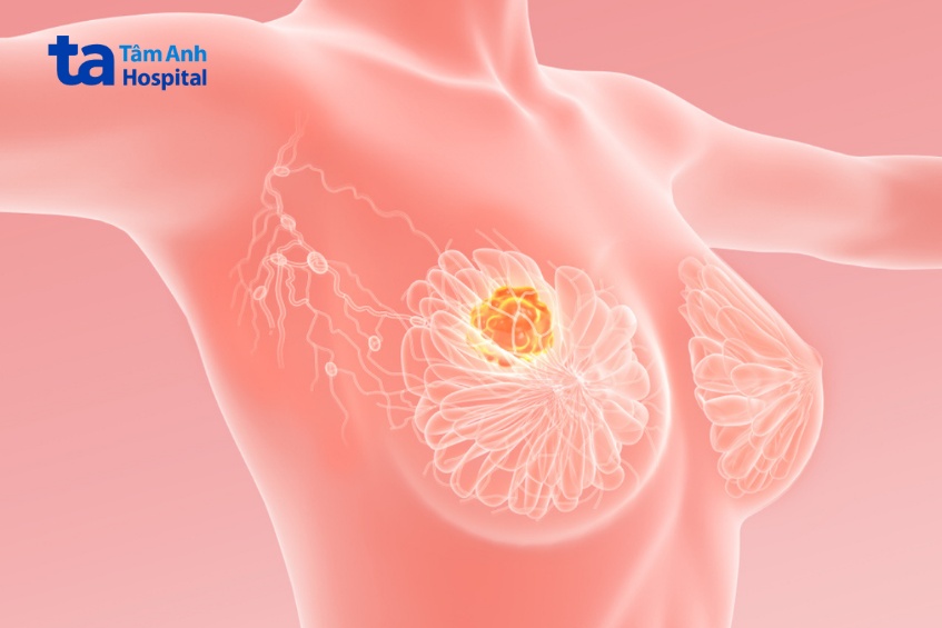 khối u lành tính có nên mổ không