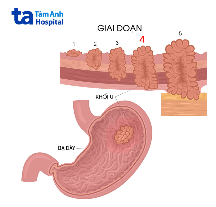 khối u ở dạ dày ở các giai đoạn