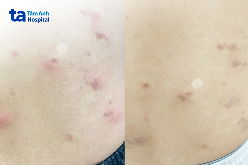 không còn ấu trùng giun móc sau điều trị